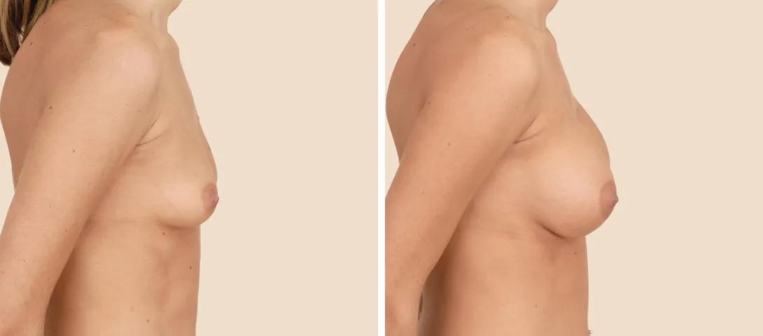 Breast augmentation before & after photo