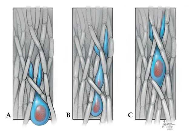 Figure. Schematic of a glioma cell (blue) migrating through brain white matter, which consists largely of oriented axons (sausage-shaped gray structures). Tumor cell migration occurs in two steps: Forward protrusion of a long finger of cell cytoplasm is followed by squeezing of the cell body, containing the cell nucleus (red), in a process that requires the molecular motor known as nonmuscle myosin II.