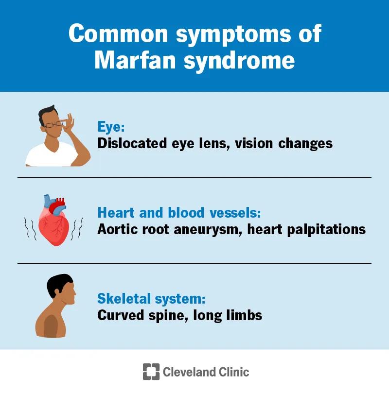 Common symptoms of Marfan syndrome that affect your eyes, heart, blood vessels and skeletal system