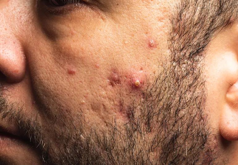 When Should Men See a Dermatologist for Adult Acne?