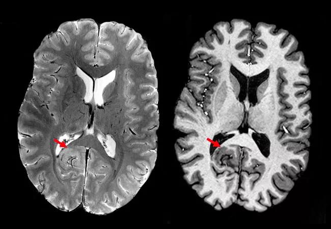 7T MRI showing a small focal cortical dysplasia