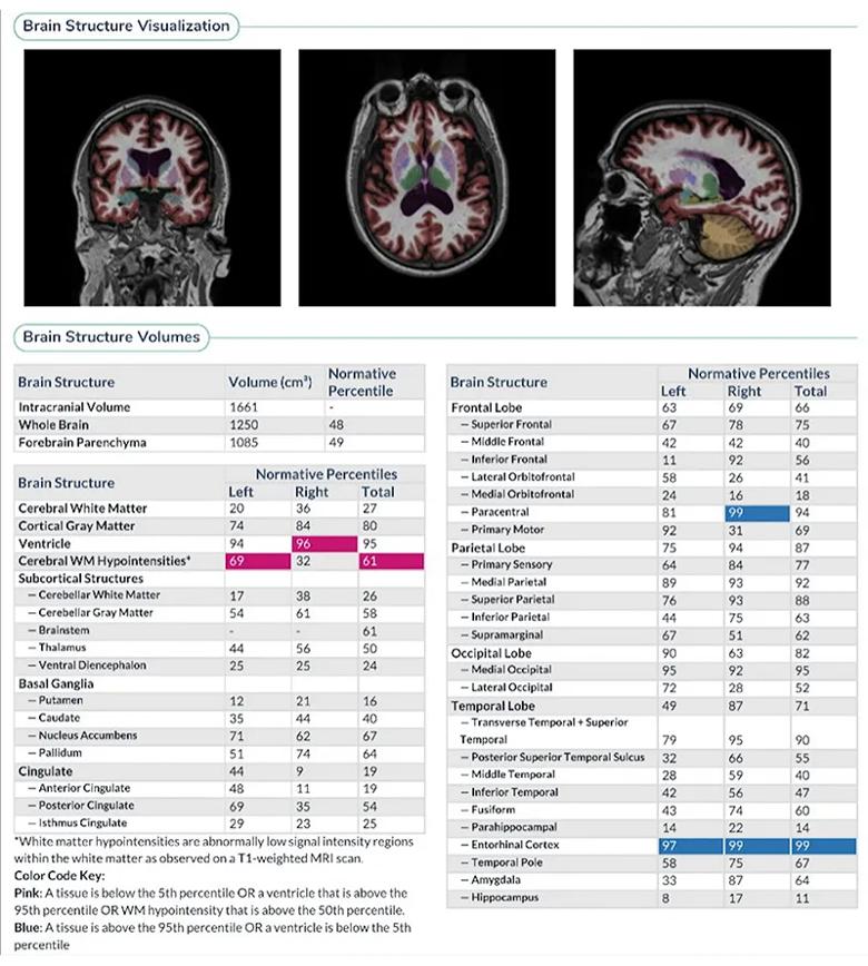 three colored brain MRIs above a large data table
