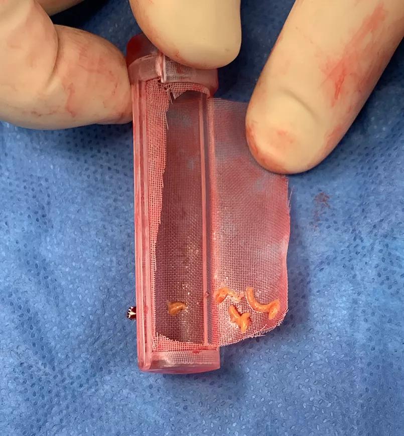 handheld filter holding trapped tissue debris
