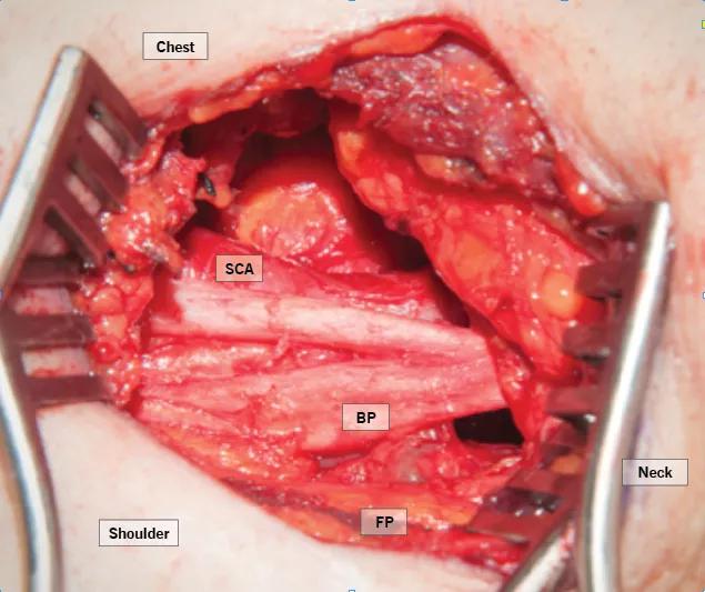 Figure 2. The brachial plexus (labeled “BP”) back in normal position after resection of the cervical rib and first rib with associated scalene muscle attachments. (SCA = subclavian artery; FP = fat pad)