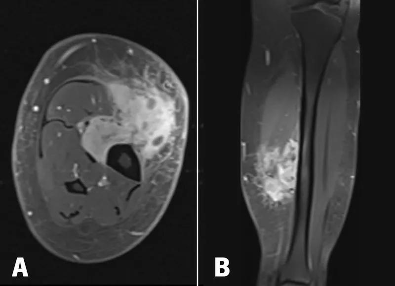 MRI