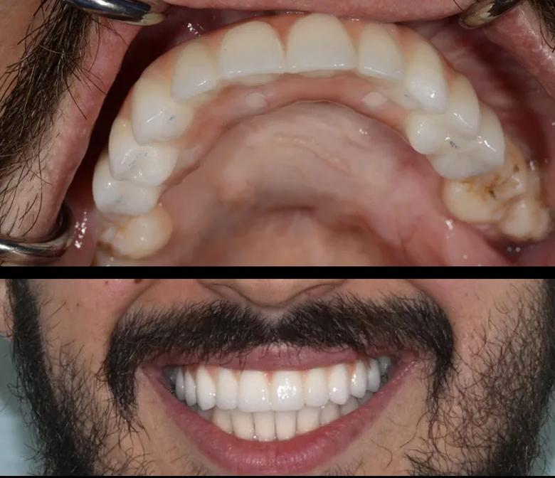 Intraoral view of the patient's completed treatment. 