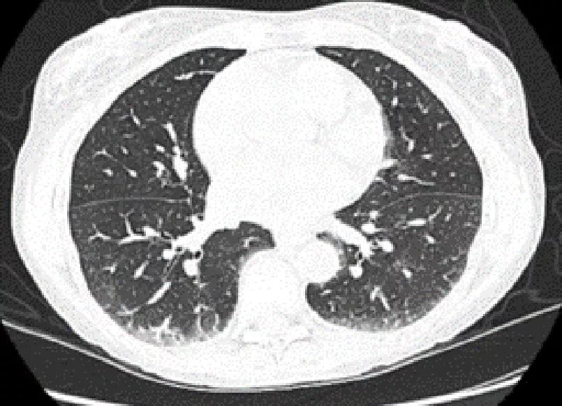 A CT chest scan shows changes of nonspecific interstitial pneumonia.