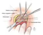 C. Ligation of inferior epigastric vessels and incision of transversalis fascia