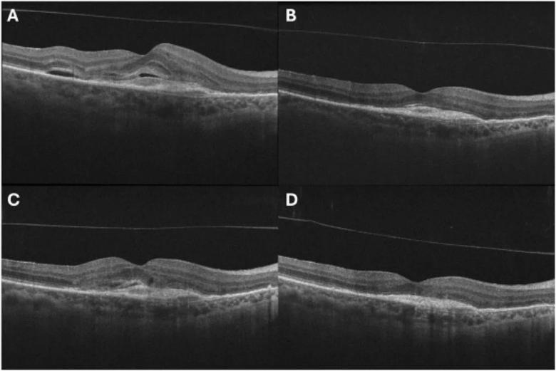 Optical coherence tomography images of macular fluid