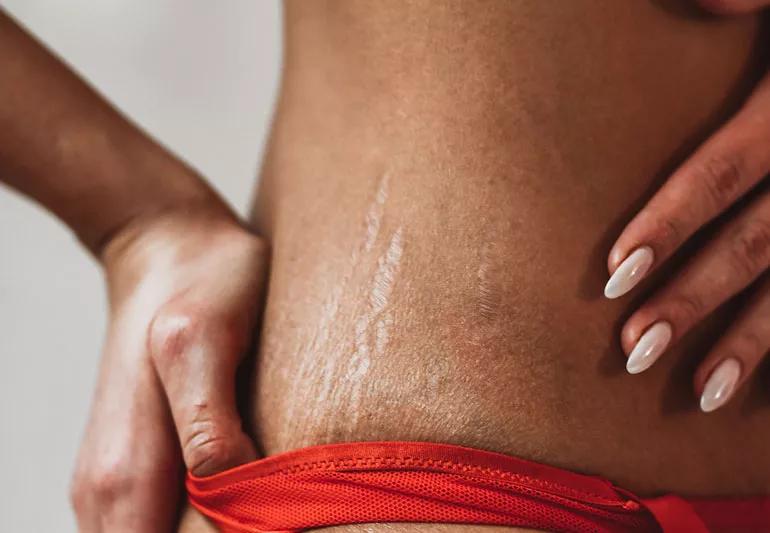 Stretch Marks That Don't Go Away: What Can You Do?