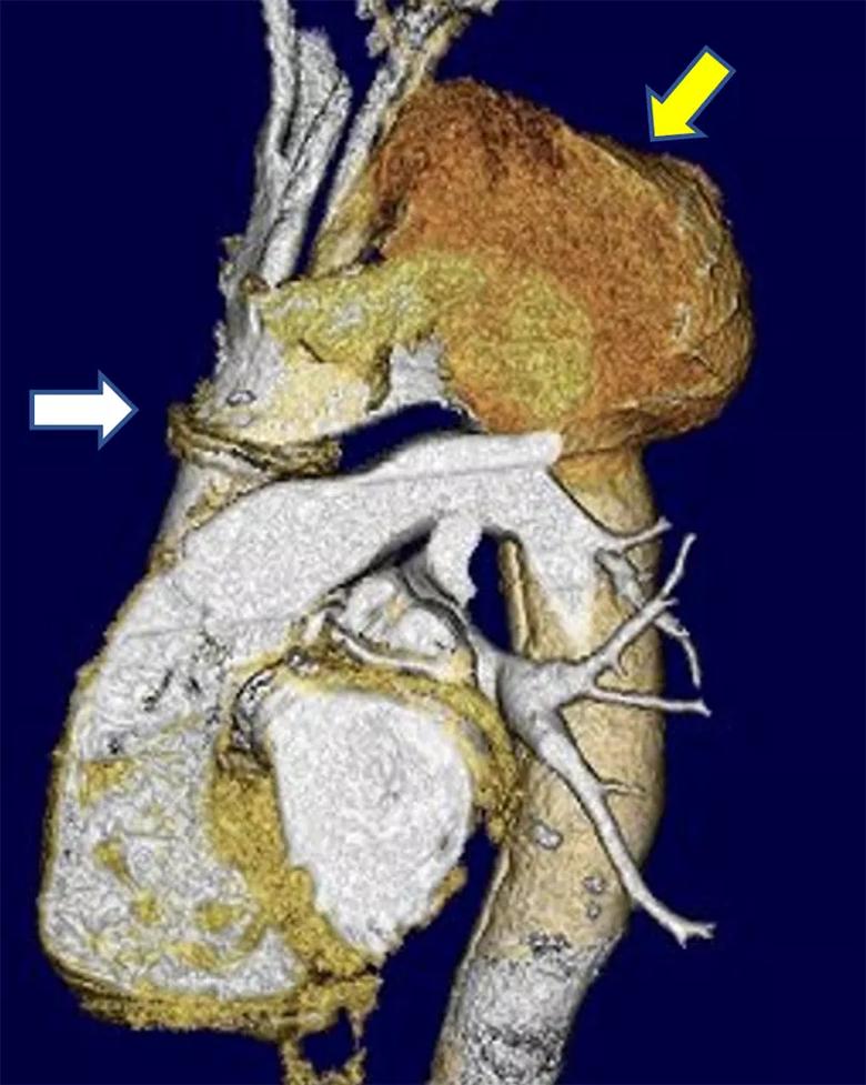 massive aortic arch aneurysm on CT scan