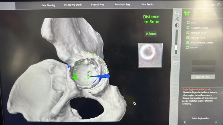 Computer screen showing robotic planning of hip replacement
