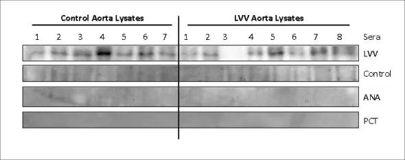 Figure 2. LVV serum shows reactivity to ~30-kd protein. Aortic lysates from controls and LVV tissues were resolved on 10 percent SDS-PAGE. After transfer, PVDF membranes were first blotted with control serum and later stripped for reprobing with LVV serum. Representative gels are shown for each serum blot. Two nonvasculitic serum controls (PCT- and ANA-positive sera) also were screened for reactivity and were negative. Subsequent mass spectroscopic analysis of the 30-kd region on protein gel identified 14-3-3 to be the most abundant protein in this region, particularly in LVV samples. (From the laboratory of Ritu Chakravarti, PhD) 