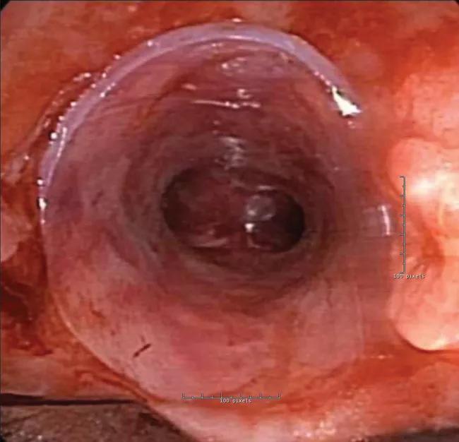 View of main carina through the patient-specific stent.