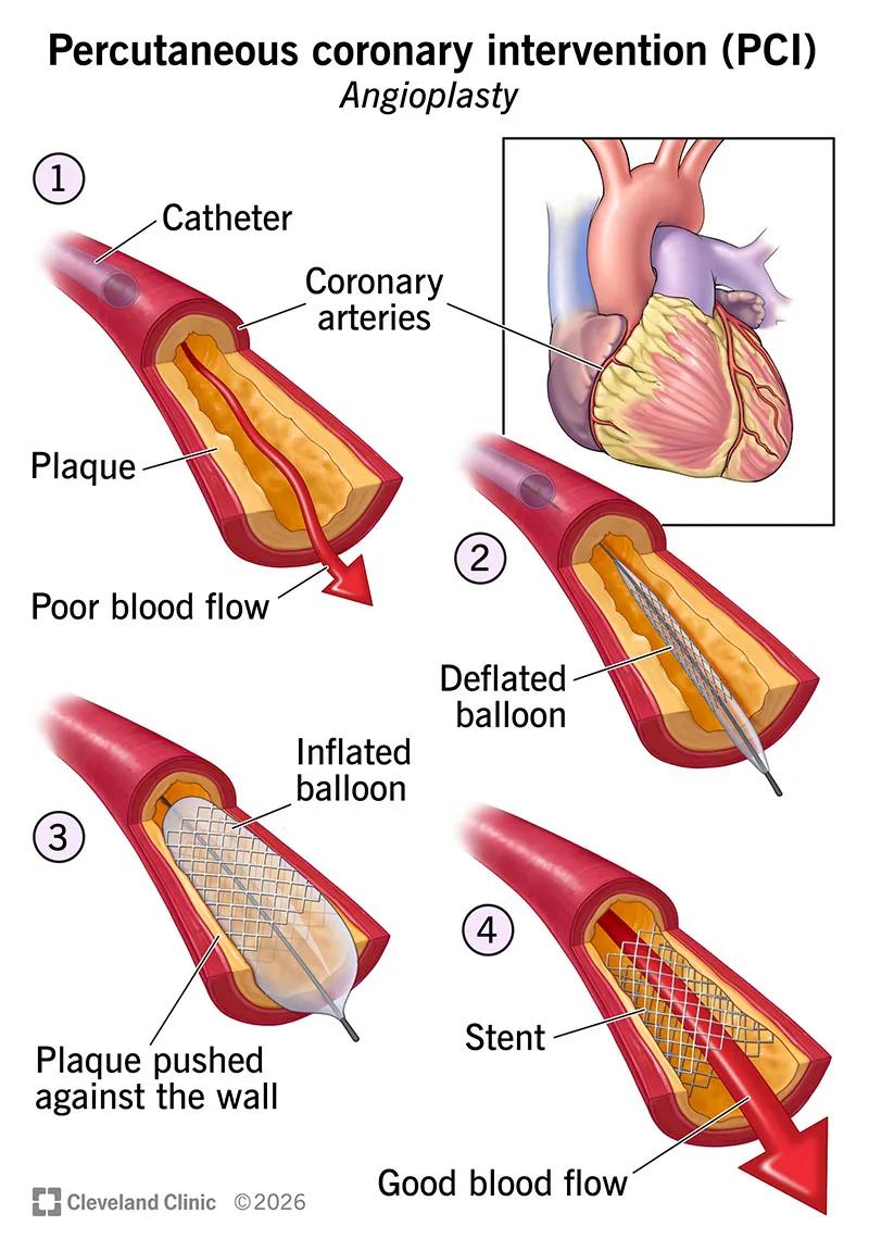 The steps in using percutaneous coronary intervention to open a blocked coronary artery