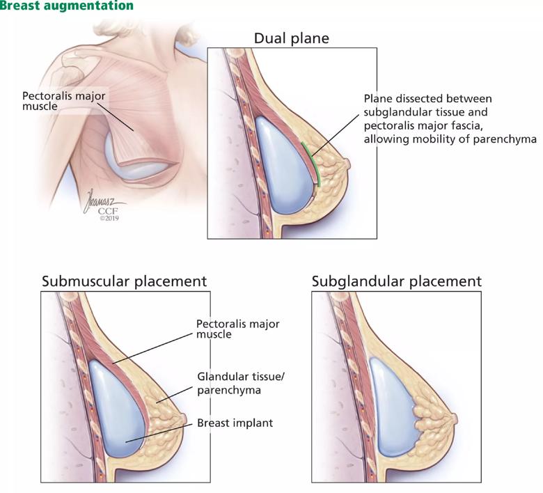 What Are the Advantages of Submuscular Breast Augmentation?