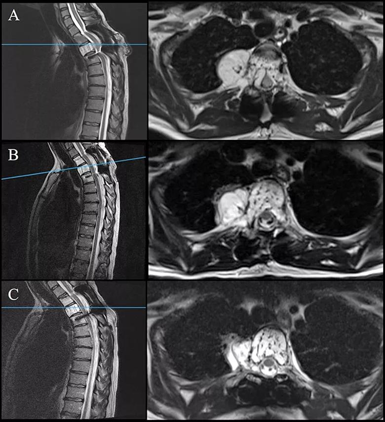 spinal hemangioma on serial MRIs