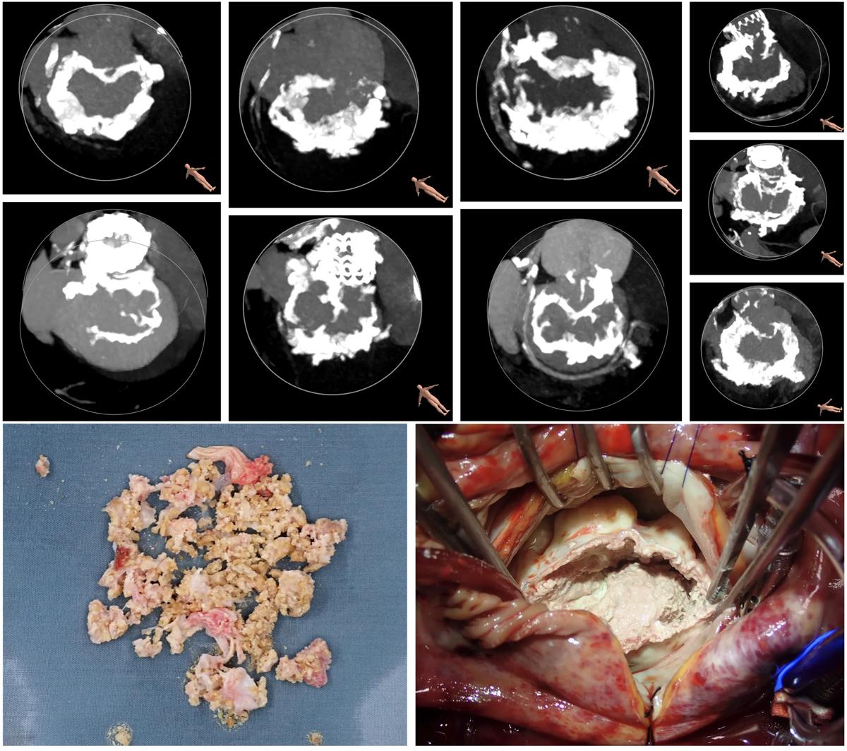 large grouping of heart scans and photos of heart valve calcification