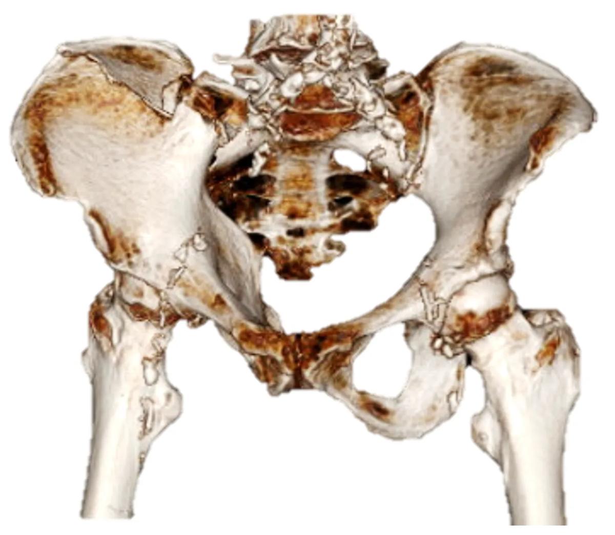 3D reconstruction CT image of iliac wing fracture and pubic rami fractures