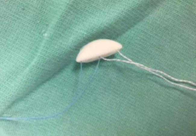 Example of preshaped, predrilled anterior glenoid allograft implants