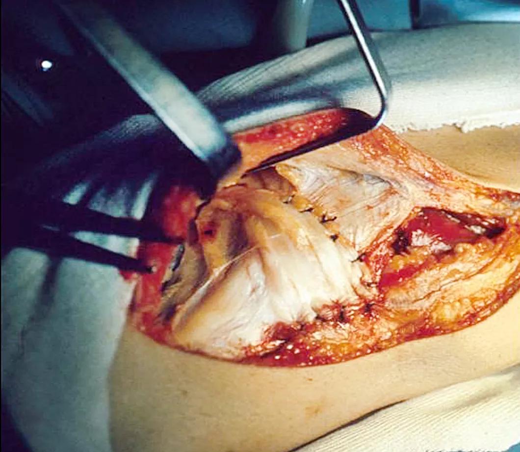 Pes anserinus transplantation