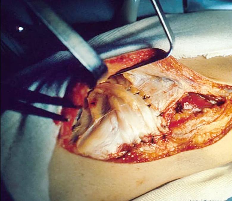 Pes anserinus transplantation