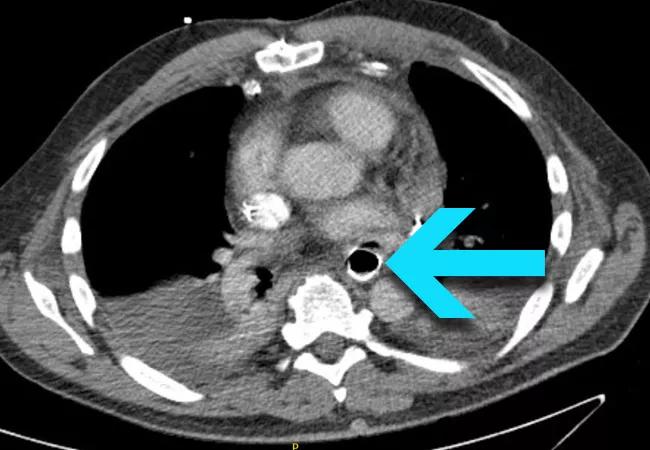 Figure 1. Contrast CT upon presentation at Cleveland Clinic showing the esophageal stent abutting the left atrium, with a rim of air visible outside the stent (arrow). 