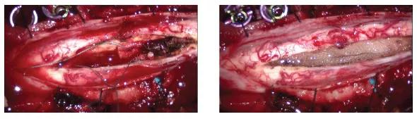 benzel-tumor-fig2