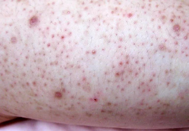 Small red bumps on arm discount