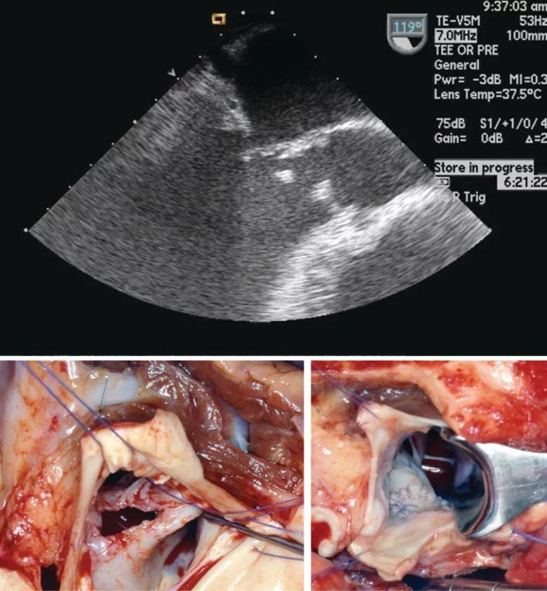 infective endocarditis vegetations spreading from aortic to mitral valve