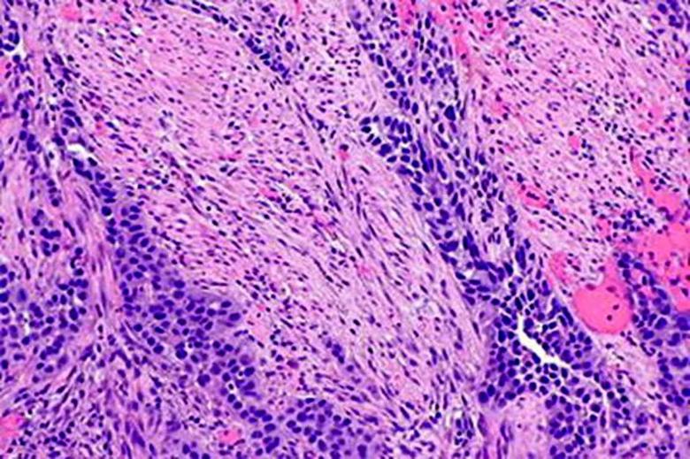 Muscle-invasive urothelial carcinoma