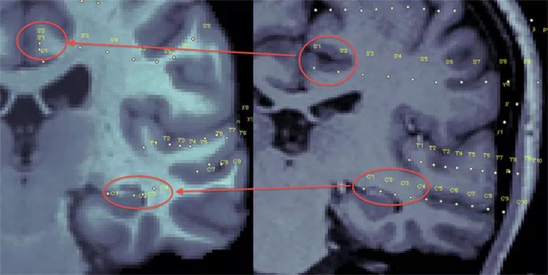 Nonlinear registration of contacts from patient to the common atlas