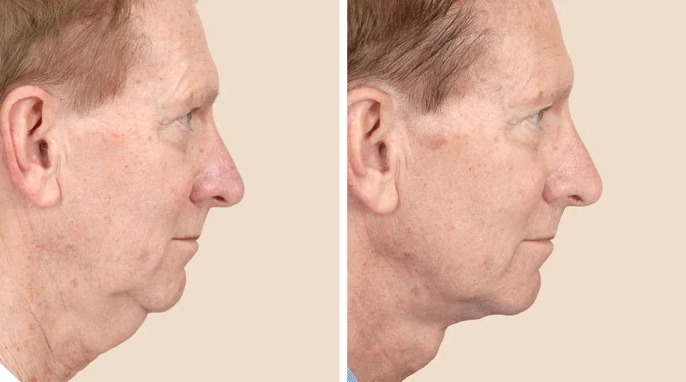 Side View - Before and After