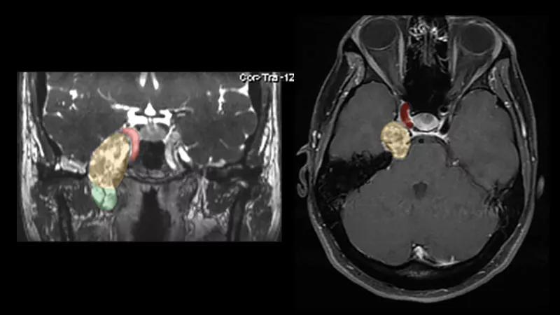two brain scans showing different views of a mass shown in color