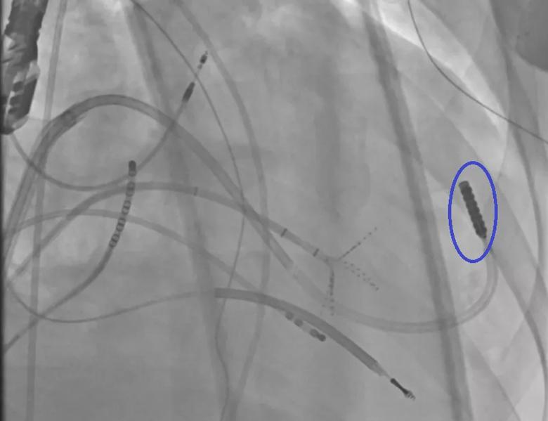 Endocardial ULTC via the mitral valve. 