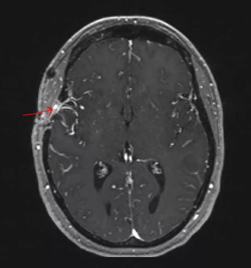 brain scan with a red arrow pointing at a white spot on the left side