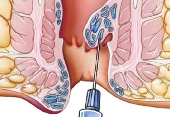 Hemorrhoids: The Definitive Guide to Medical and Surgical Treatment