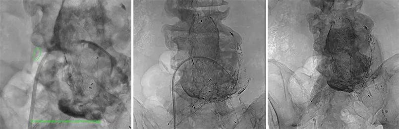 three CT scans from stages of an aortic embolization procedure