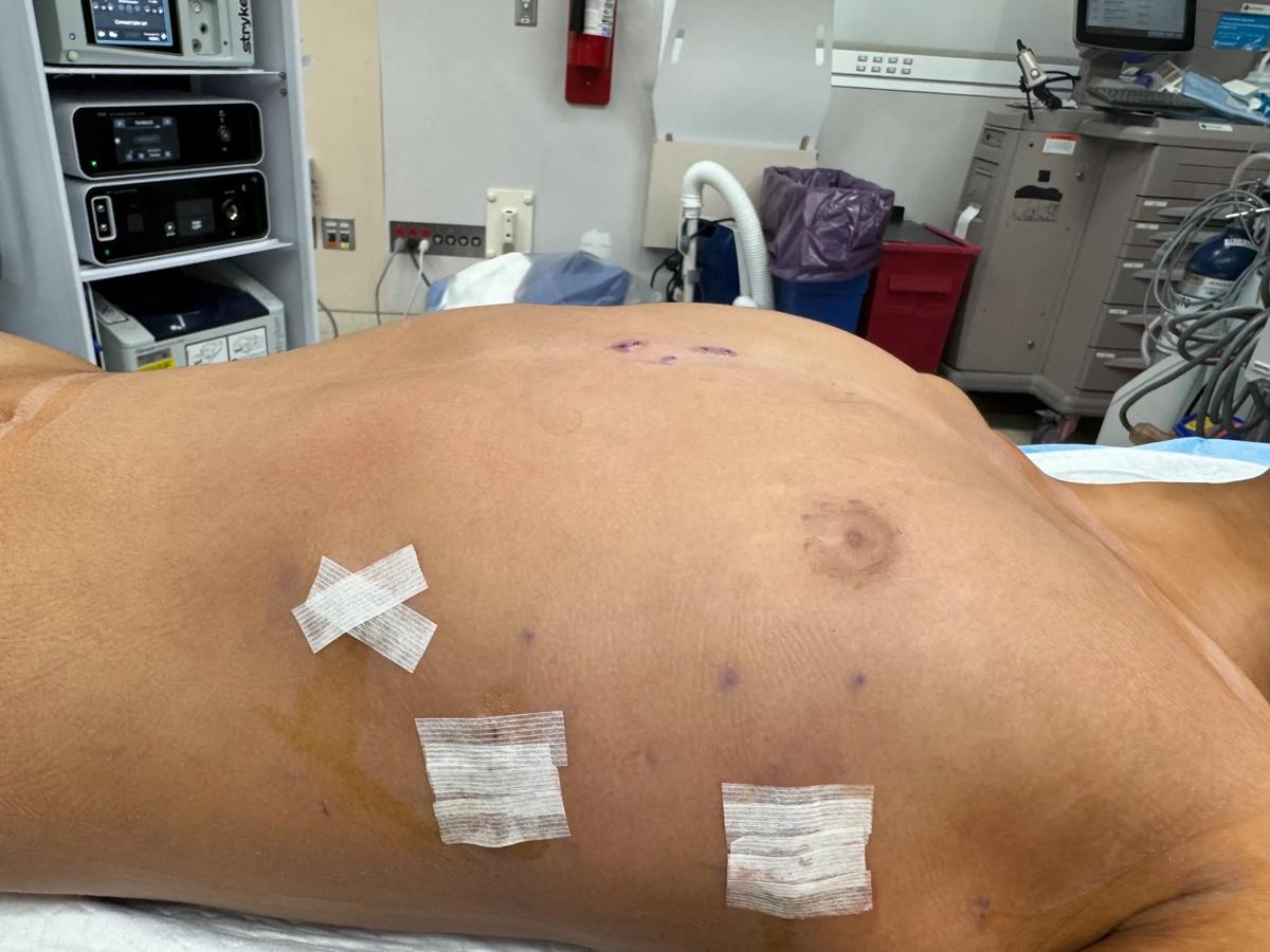 Photo of patient's chest.