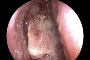 endoscopic view of nasal cavity