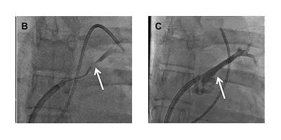 Figures B and C. Angiograms of the left atrium demonstrating subtotal occlusion of the left superior pulmonary vein (B) and complete vessel patency following placement of a drug-eluting stent in the ostium of the left superior pulmonary vein (C).