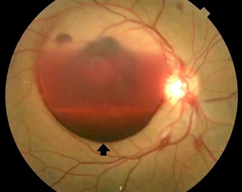 A dilated fundus photograph of the patient’s right eye shows large subhyaloid hemorrhage (arrow).