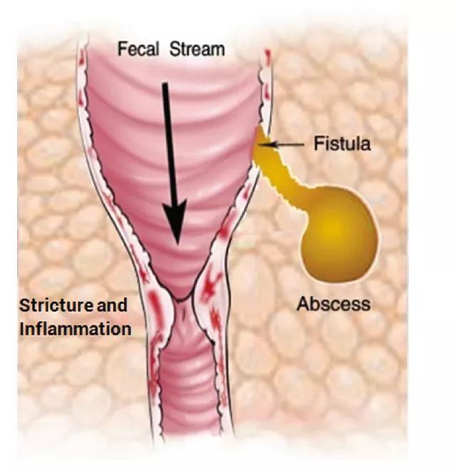 Stricture-abscess-diagram