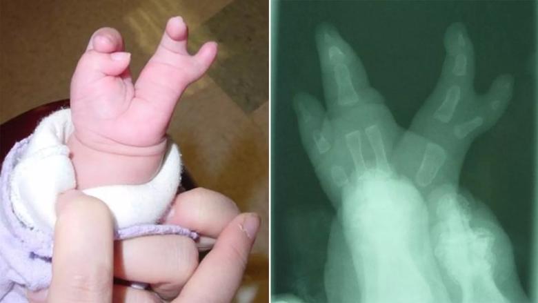 Daisey Yu hand reconstruction Cleveland Clinic