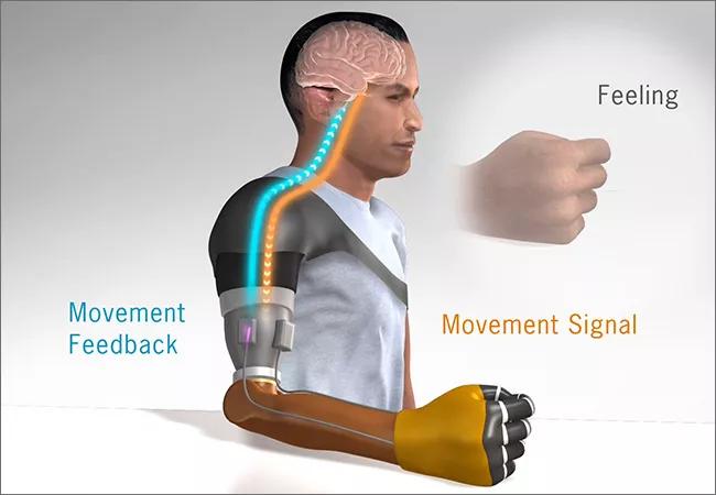 Prosthetic Function Advances with First Demonstration of Illusory Movement  Perception in Amputees