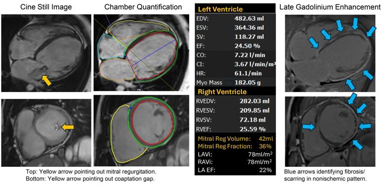 multi-panel figure with scans of the heart and data charts