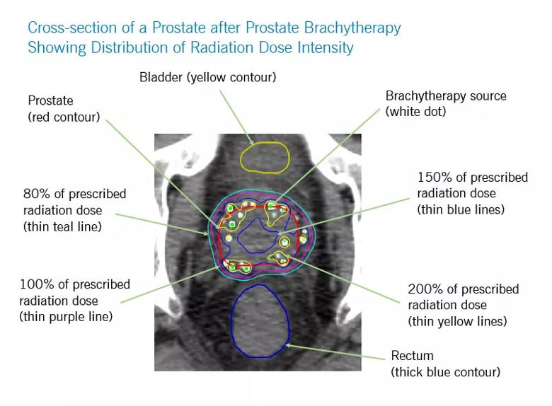 Localized therapy for high risk prostate cancer