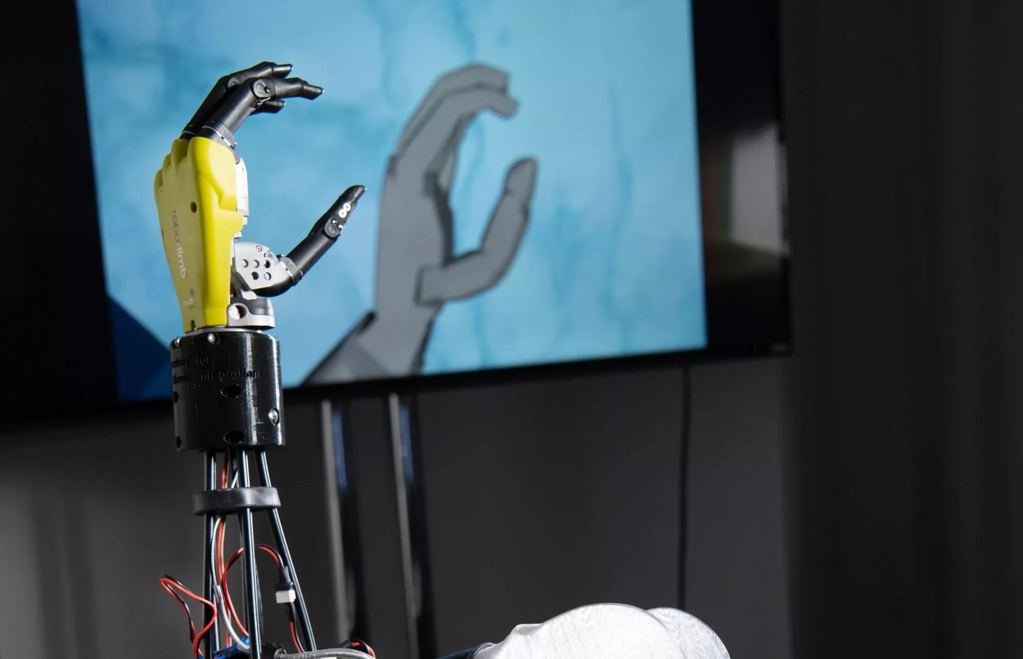 What Is A Bionic Arm