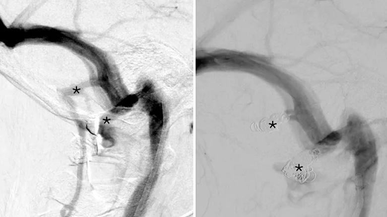 side-by-side scans of a blood vessel in the brain
