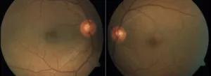 Uveitis in the eye